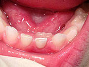 Baby Teeth - Pediatric Dentist Dr. Jenna Schulten